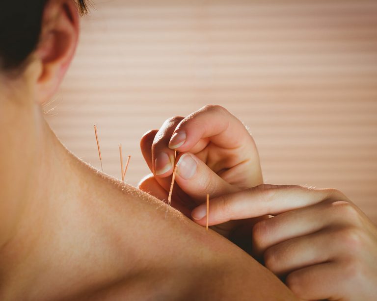 Acupuncture in StokeonTrent, AACP qualified Physiotherapist