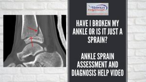 have-i-broken-my-ankle-or-is-it-just-a-sprain-ankle-sprain-assessment-and-diagnosis-help-video