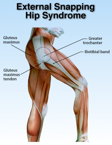 Left Snapping Hip What's the click in my hip? Is the click a problem? Snapping hip syndrome.