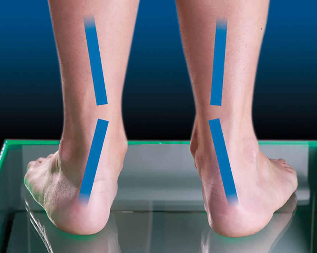 shoes that limit pronation