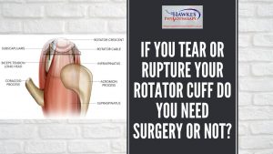 if-you-tear-or-rupture-your-rotator-cuff-do-you-need-surgery-or-not