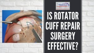 is-rotator-cuff-repair-surgery-effective