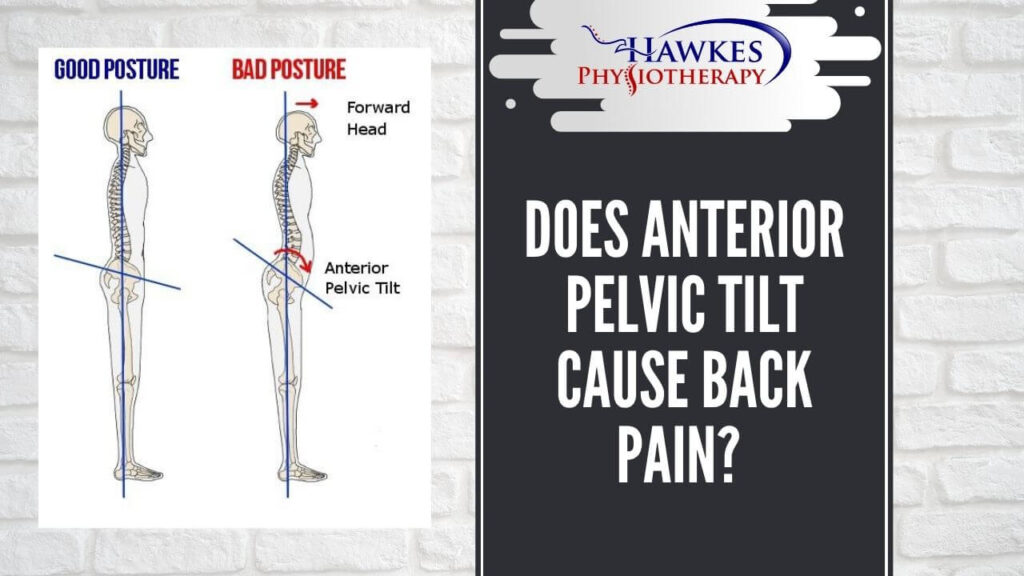 Does anterior pelvic tilt cause back pain?