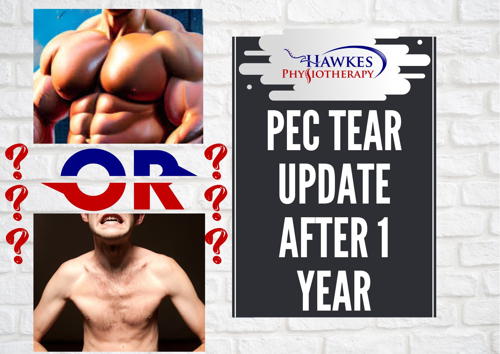 Pec tear update after 1 year